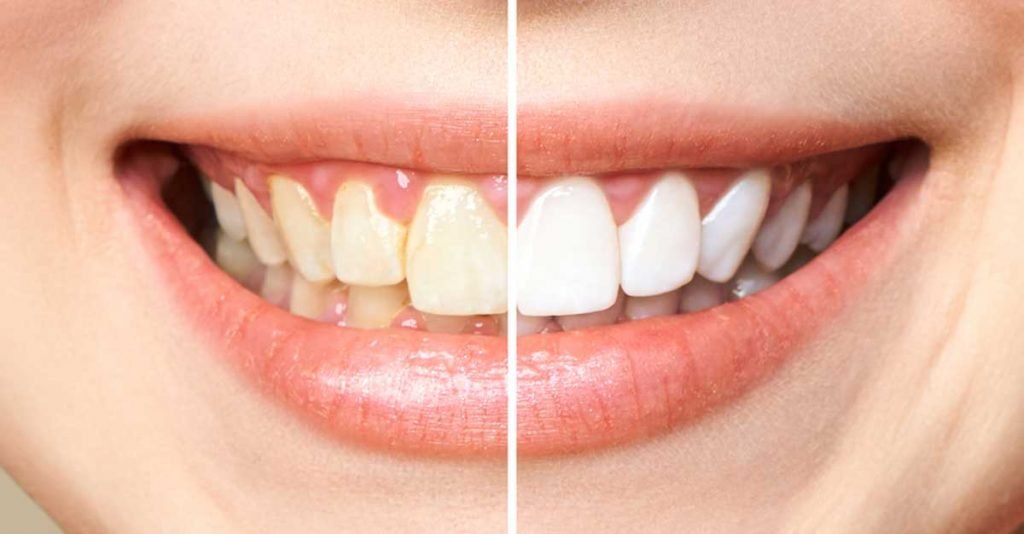 9 Foods That Damage The Teeth Damage-The-Teeth