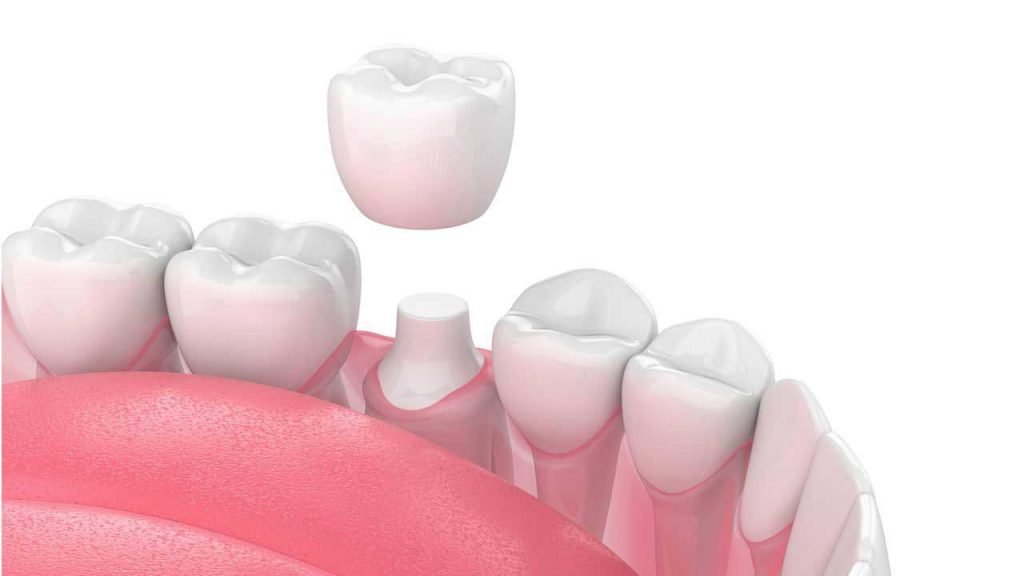 Benefits of Dental Crowns