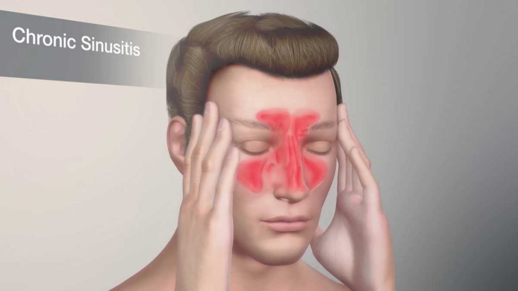 How To Recognize And Deal With A Sinus Infection Sinus Infection